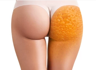 What is cellulite and the various treatments available