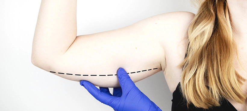 What is arm lift surgery?