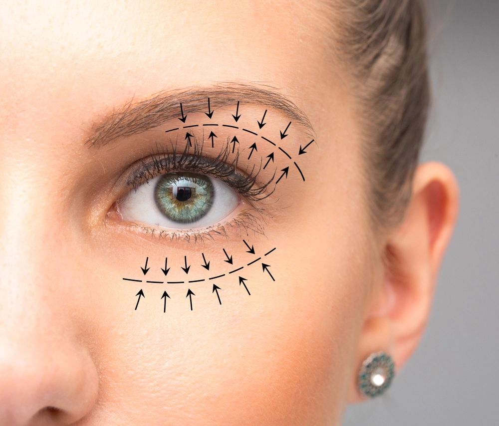 5 things to expect from your eyelid surgery recovery
