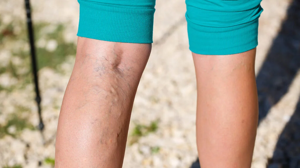 Varicose vein problems?